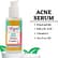 Anti Acne Kit Pimple Removal Face Serum 30ml and Foaming Toner Cleanser Wash 150ml