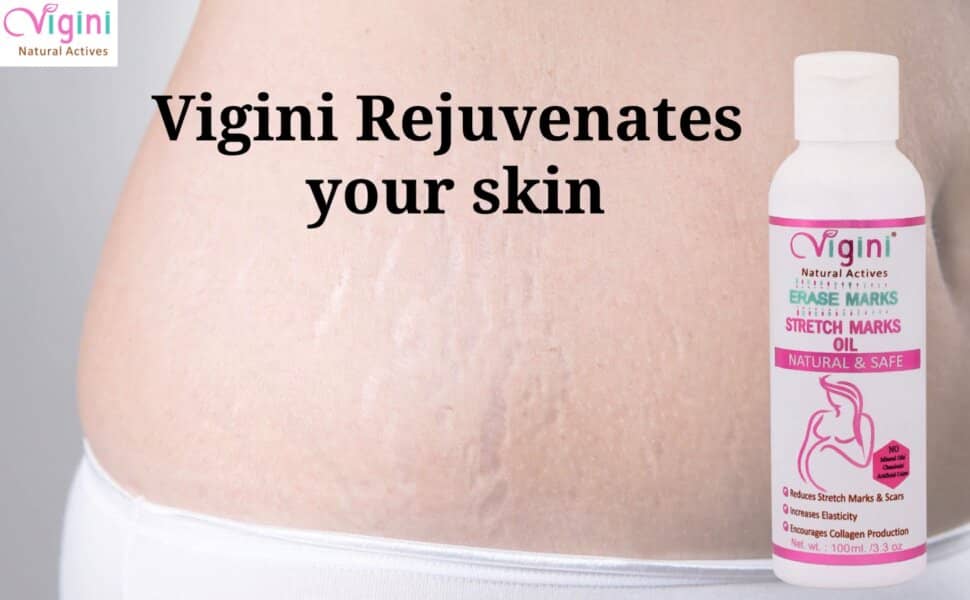 Say Goodbye To Stretch Marks With Vigini’s Stretch Marks Removal Cream: A Comprehensive Review